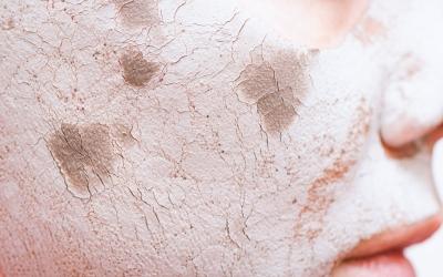 Как предотвратить сухость лица в морозы